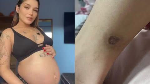 A picada da aranha trouxe traumas para Ketisley - Imagem: Divulgação/ G1