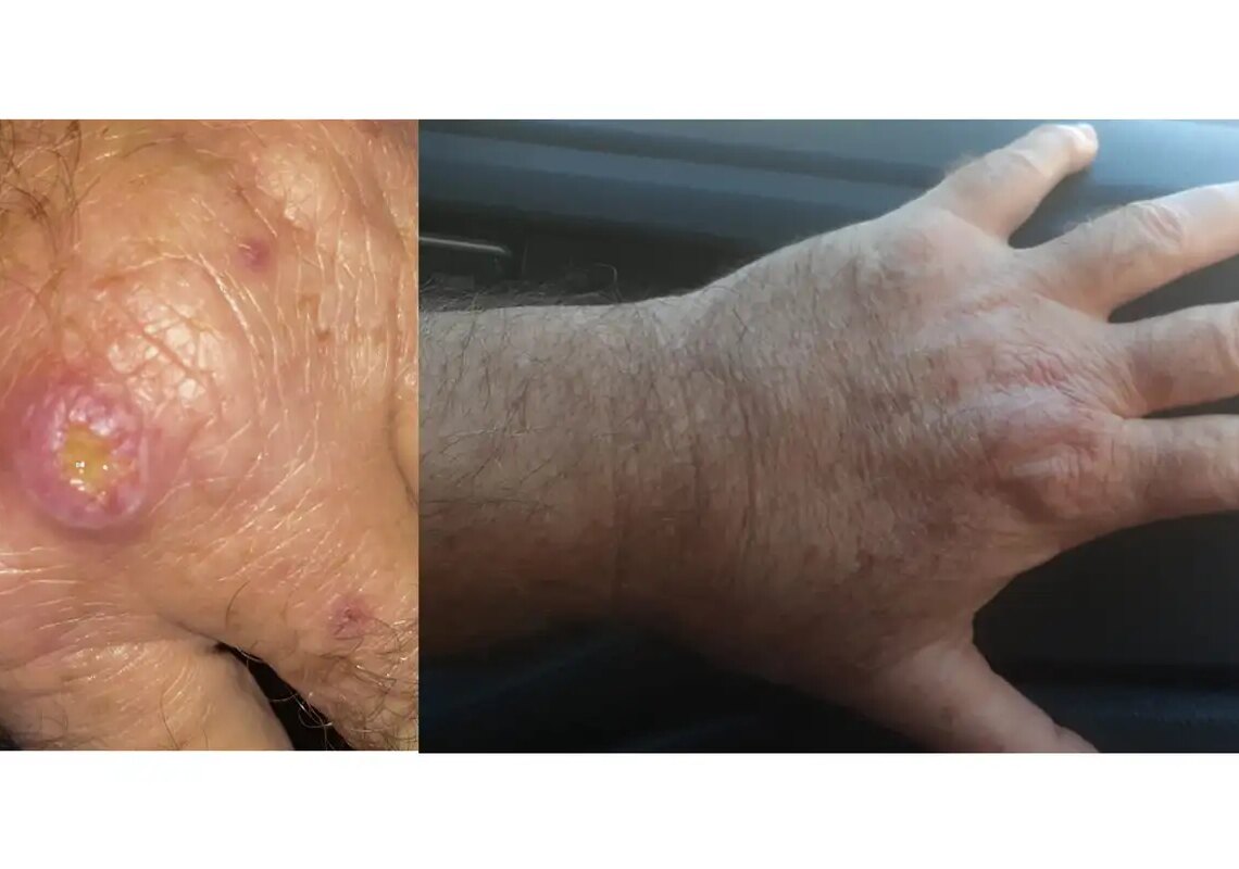 Especialistas alertam para a falta de informação sobre a leishmaniose