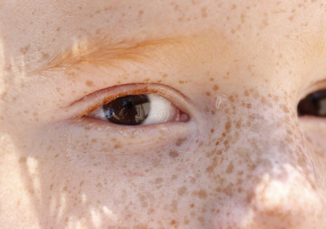 Reflexo branco nos olhos: entenda condição que assusta pais