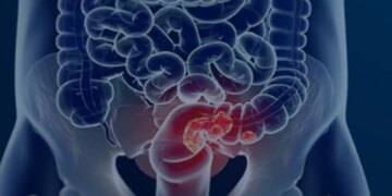 Pacientes com câncer colorretal são diagnosticados em estágio avançado