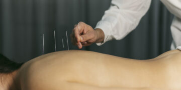 Lei regulamenta exercício profissional da acupuntura — Senado Notícias