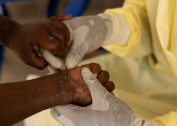Brasil registra 88 casos de Mpox em 2026; saiba como evitar a doença