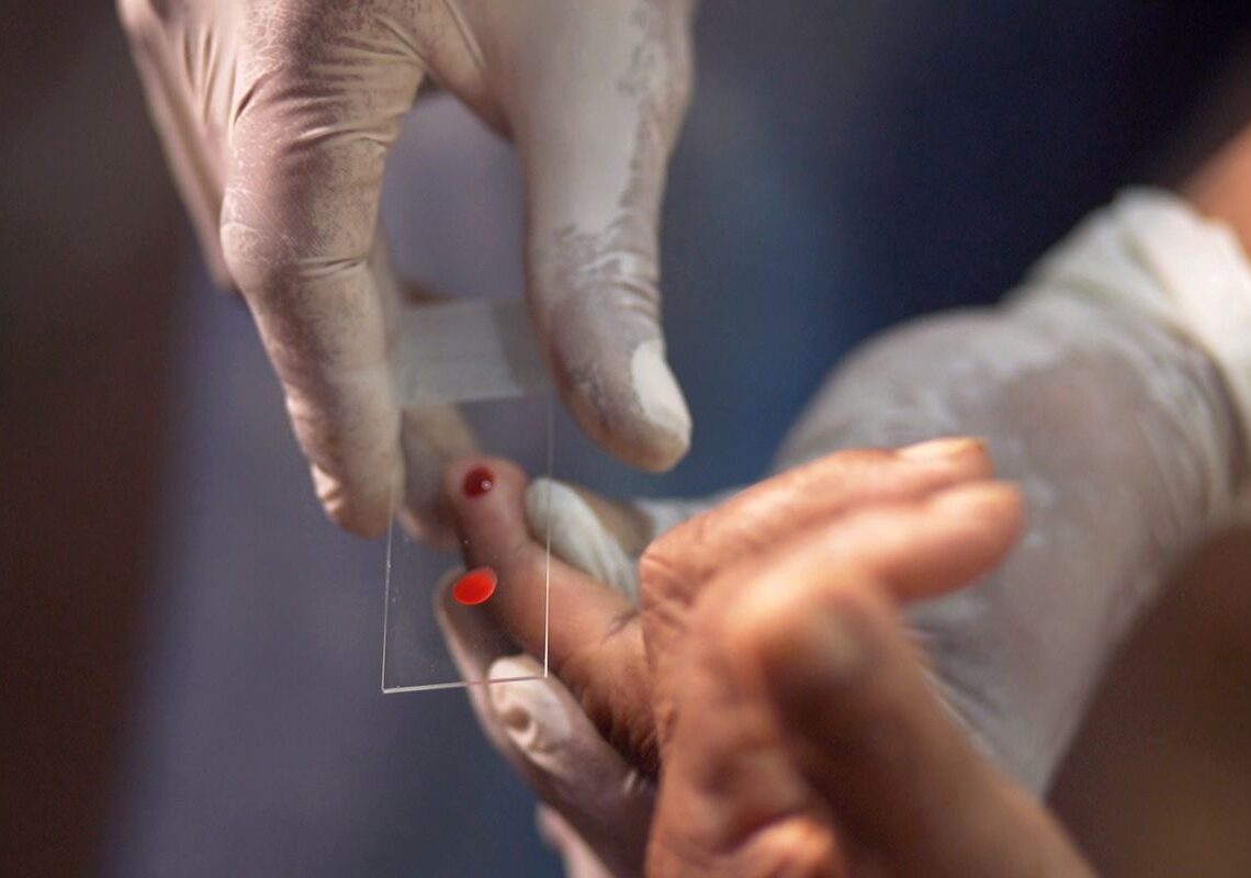 SUS começa a usar novo tratamento contra a malária em crianças