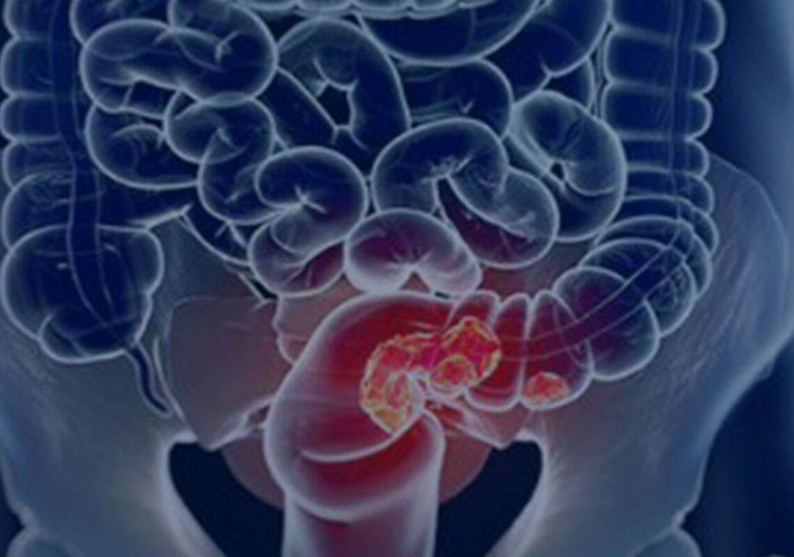 Rastreamento para câncer colorretal pode ser implementado no SUS