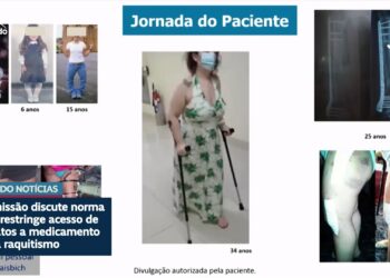 Debatedores na CDH defendem ampliar uso de medicamento contra raquitismo — Senado Notícias