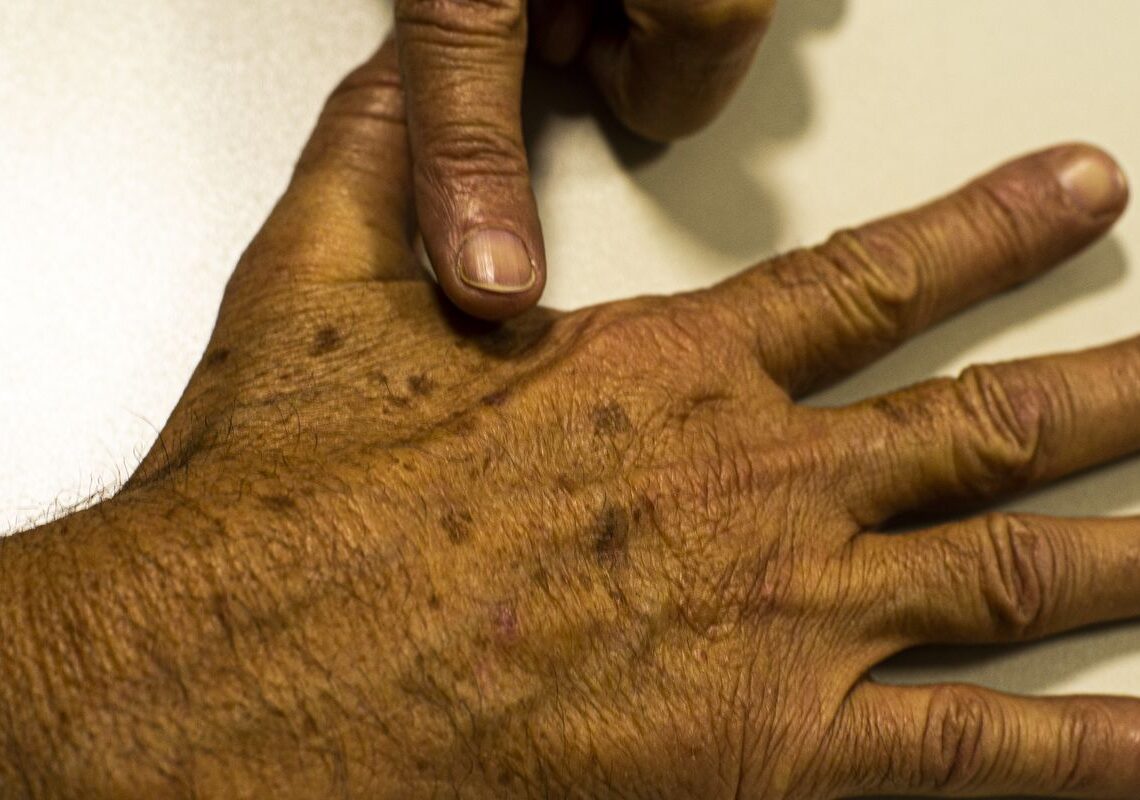 Desinformação sobre câncer de pele afeta diagnóstico, diz instituição