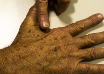 Desinformação sobre câncer de pele afeta diagnóstico, diz instituição