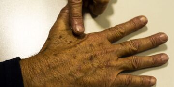 Desinformação sobre câncer de pele afeta diagnóstico, diz instituição