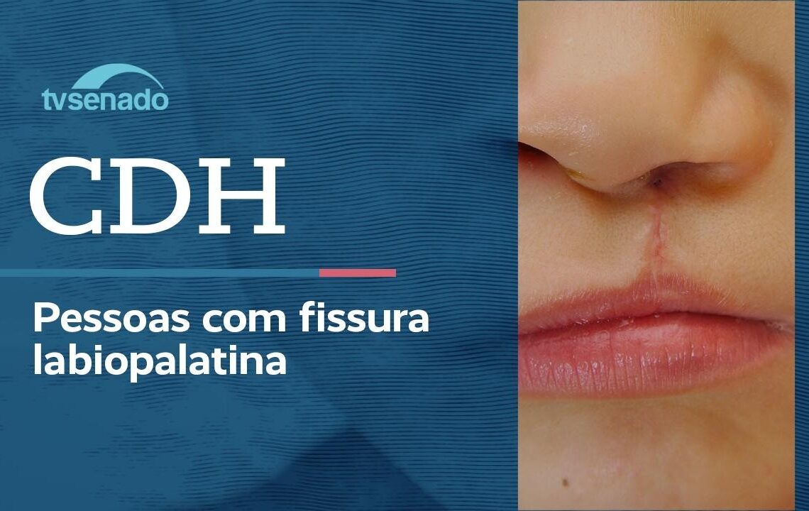 Vídeo: Ao vivo: CDH discute atenção integral para fissura labiopalatina – 22/6/26