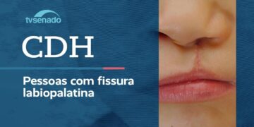 Vídeo: Ao vivo: CDH discute atenção integral para  fissura labiopalatina – 22/6/26