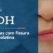 Vídeo: Ao vivo: CDH discute atenção integral para fissura labiopalatina – 22/6/26