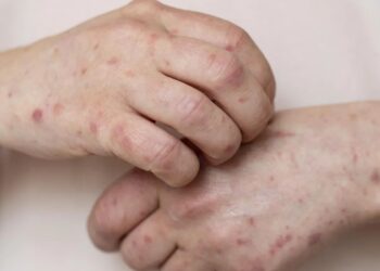 Copa do Mundo reforça importância da vacinação contra sarampo; infectologista da Hapvida orienta viajantes