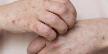 Copa do Mundo reforça importância da vacinação contra sarampo; infectologista da Hapvida orienta viajantes