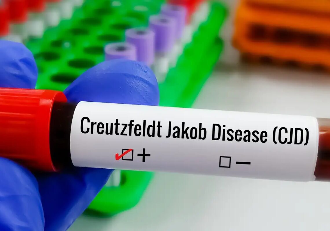 Entenda Doença de Creutzfeldt-Jakob e busca por tratamento