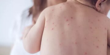 Estado de São Paulo reforça necessidade de vacinação contra o sarampo