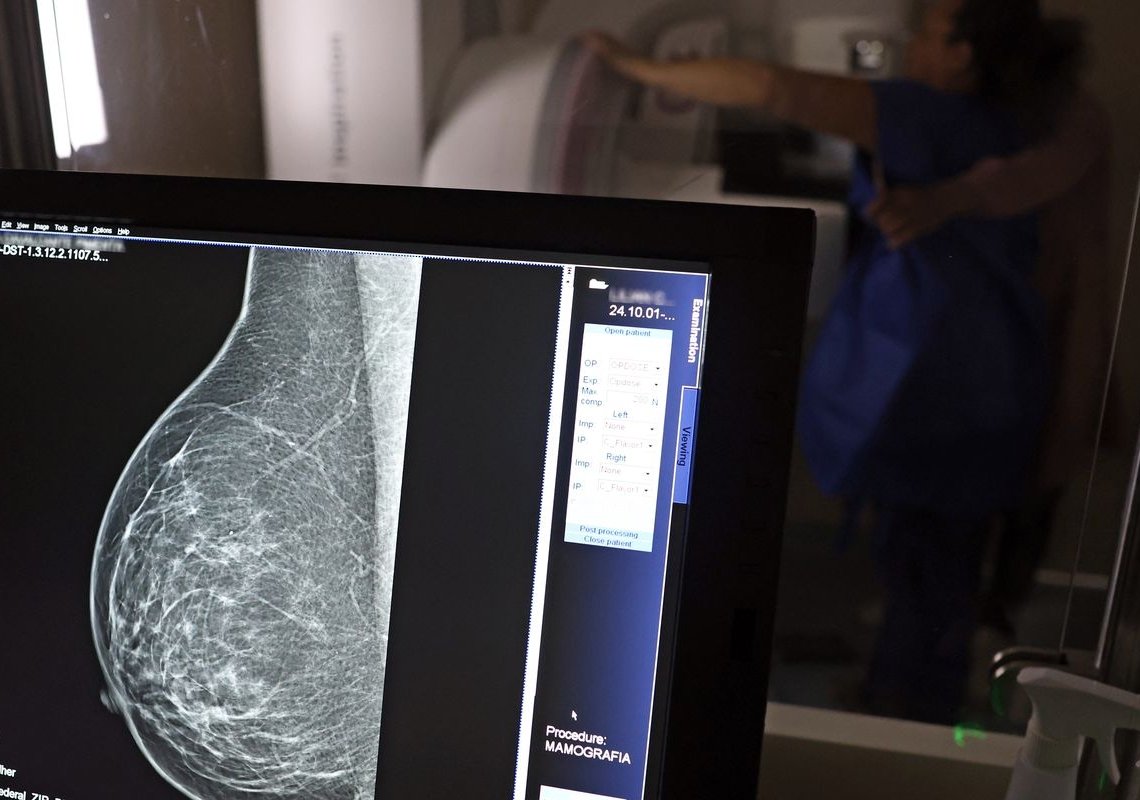 Entidades alertam médicos sobre pedidos de mamografia digital