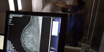Entidades alertam médicos sobre pedidos de mamografia digital