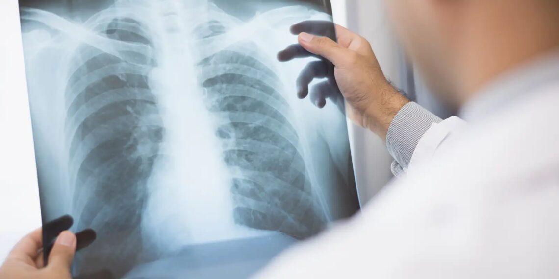 Anvisa aprova novo medicamento para câncer de pulmão avançado