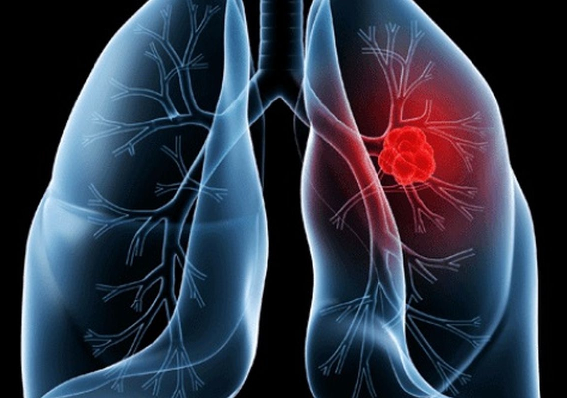 Saiba o que é adenocarcinoma pulmonar, câncer que atinge o Papa Leão XIV