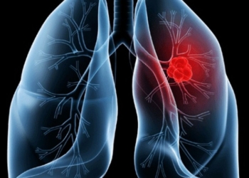 Saiba o que é adenocarcinoma pulmonar, câncer que atinge o Papa Leão XIV