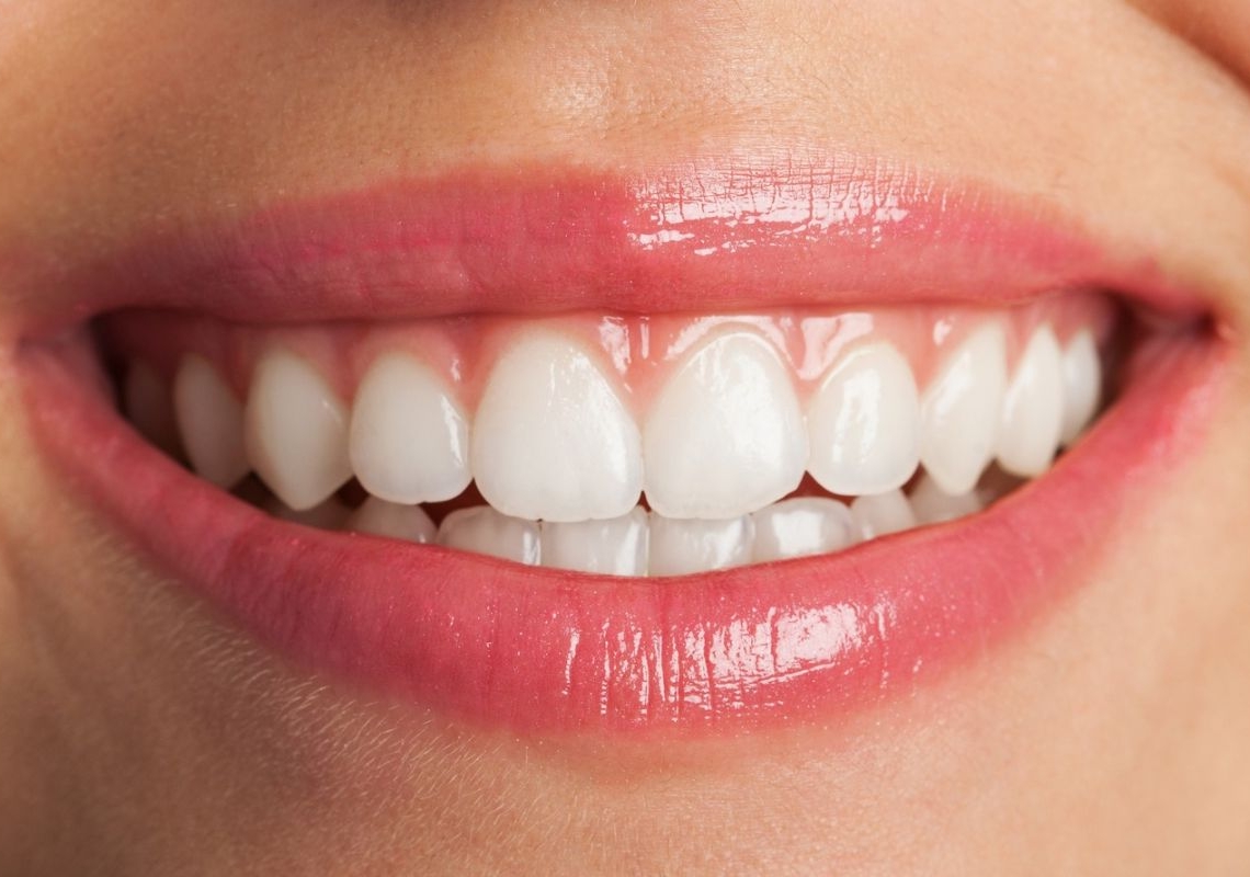 Sorriso de filtro: os perigos das receitas caseiras e dos clareadores de internet