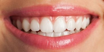 Sorriso de filtro: os perigos das receitas caseiras e dos clareadores de internet 