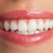 Sorriso de filtro: os perigos das receitas caseiras e dos clareadores de internet 